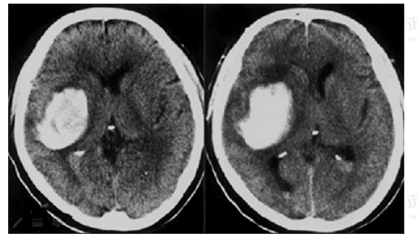 男55歲，左側(cè)肢體偏癱4小時(shí)，有高血壓史，診斷為